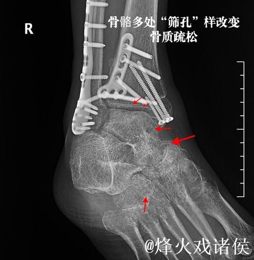 加福德:右脚踝感觉好多了,这是长时间以来感觉最好的一次 加福德:右脚踝感觉好多了,这是长时间以来感觉最好的一次